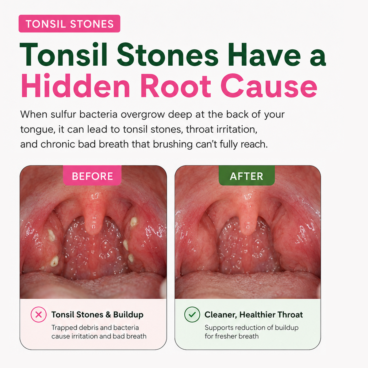 Deep-Clean Tonsil Stone Removal & Fresh Breath Oral Care Formula