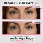 Under-Eye Red Light Beauty Device – Gentle LED Eye Care for Tired-Looking Eyes