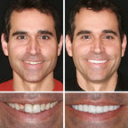 Medical Full Denture with Strong Suctiond Custom-Fit Full Functional Dentures