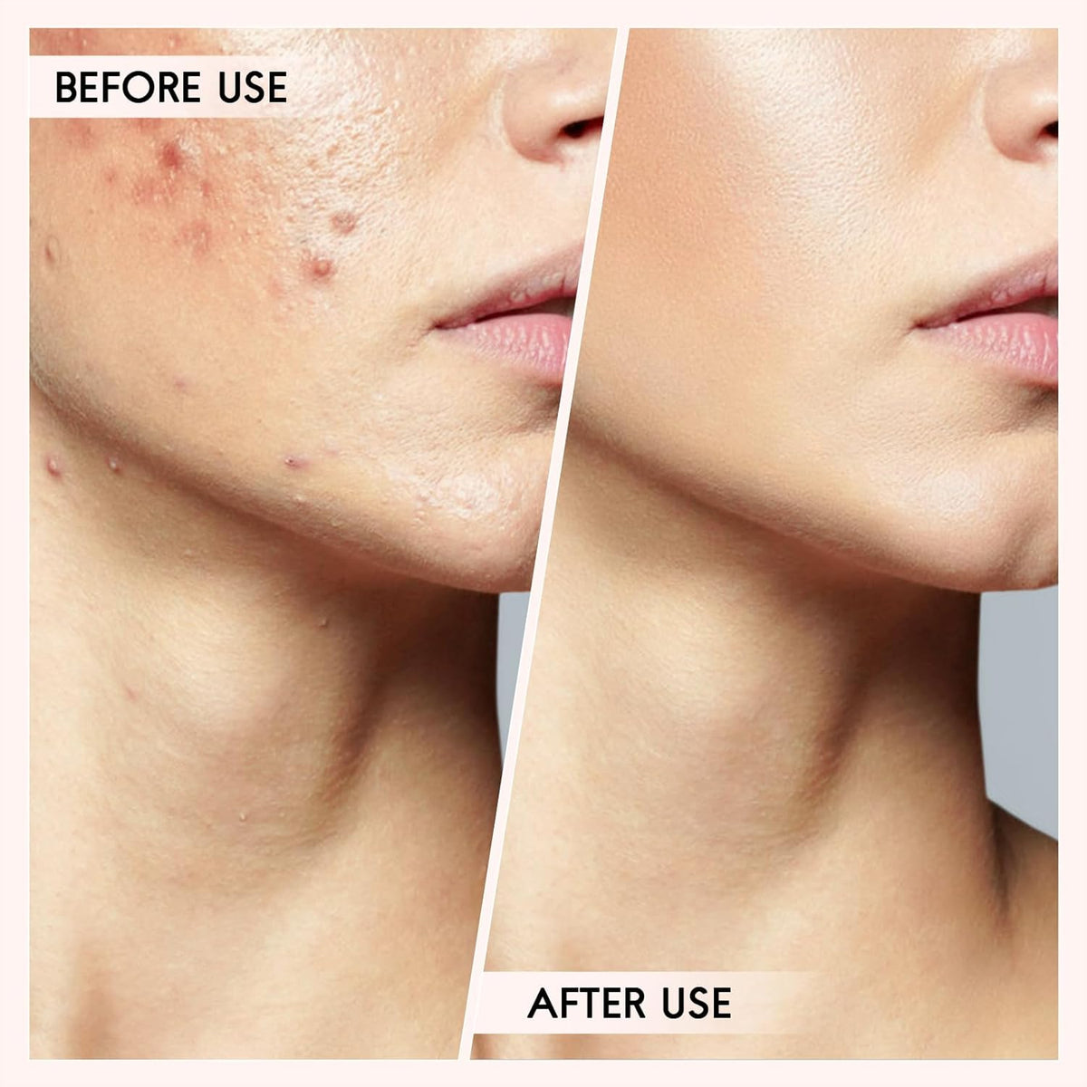 Pimple & Blackhead Remover Tool Kit