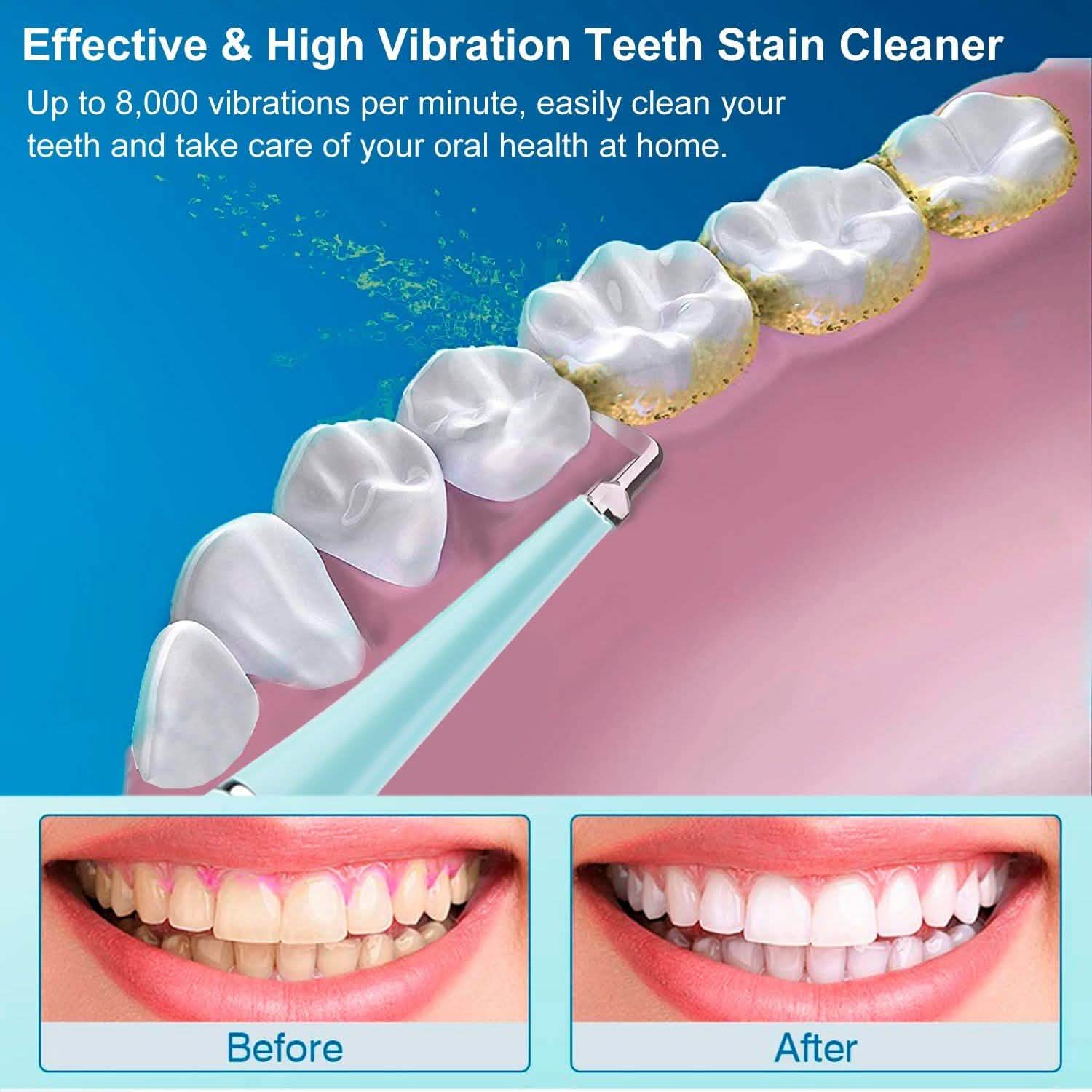 Electric Tartar Remover For Teeth