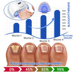 NailCure™ - Nail Fungus Laser Treatment Solution (50% DISCOUNT)