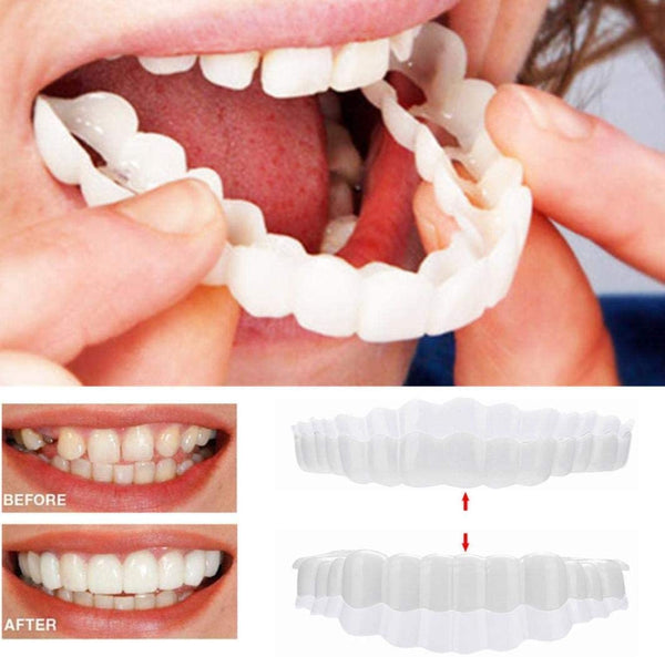 Niki | On Smile Veneers (Upper and Lower Jaw Included)