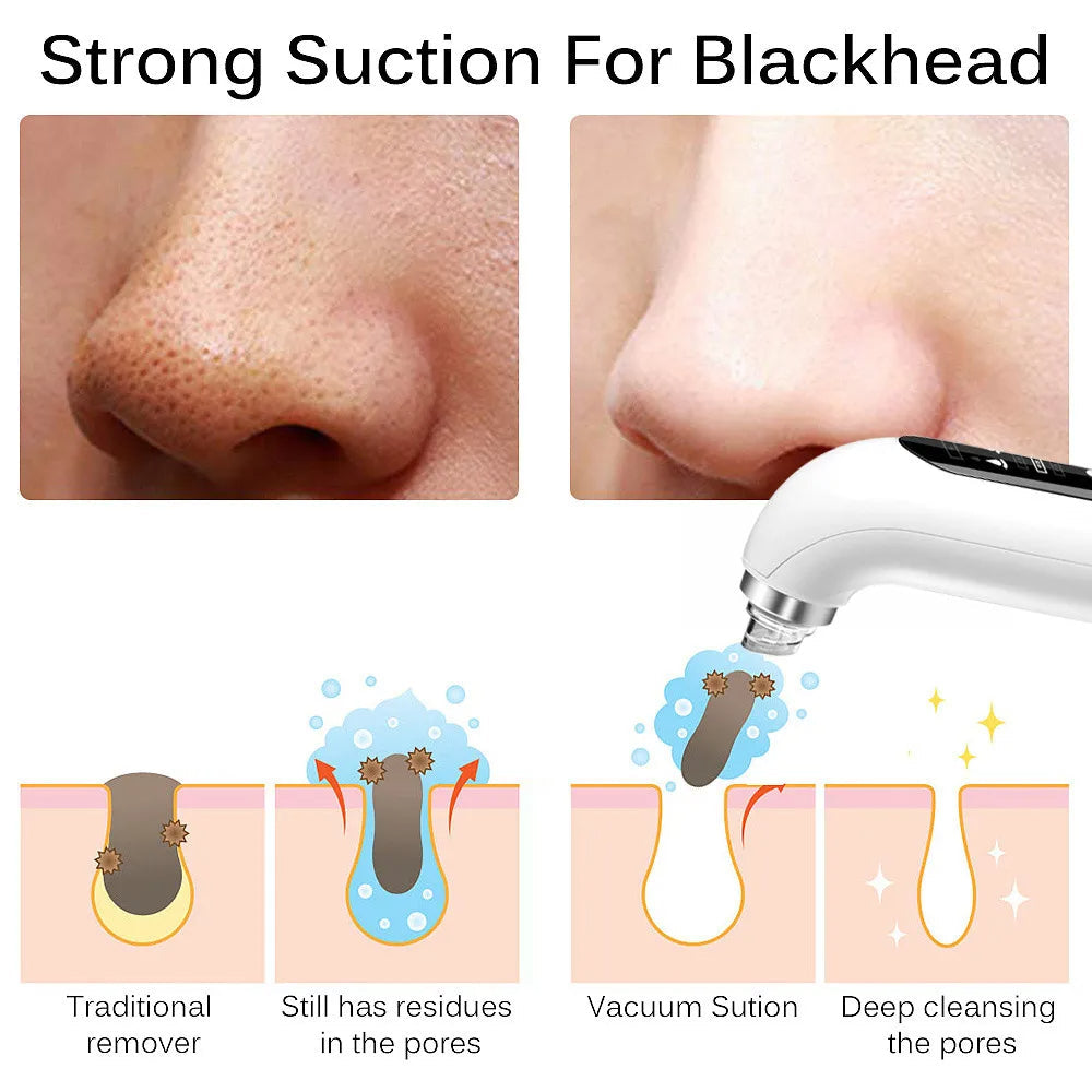 Niki | Facial Pore Cleanser Vacuum - Gentle Blackhead Extraction Tool