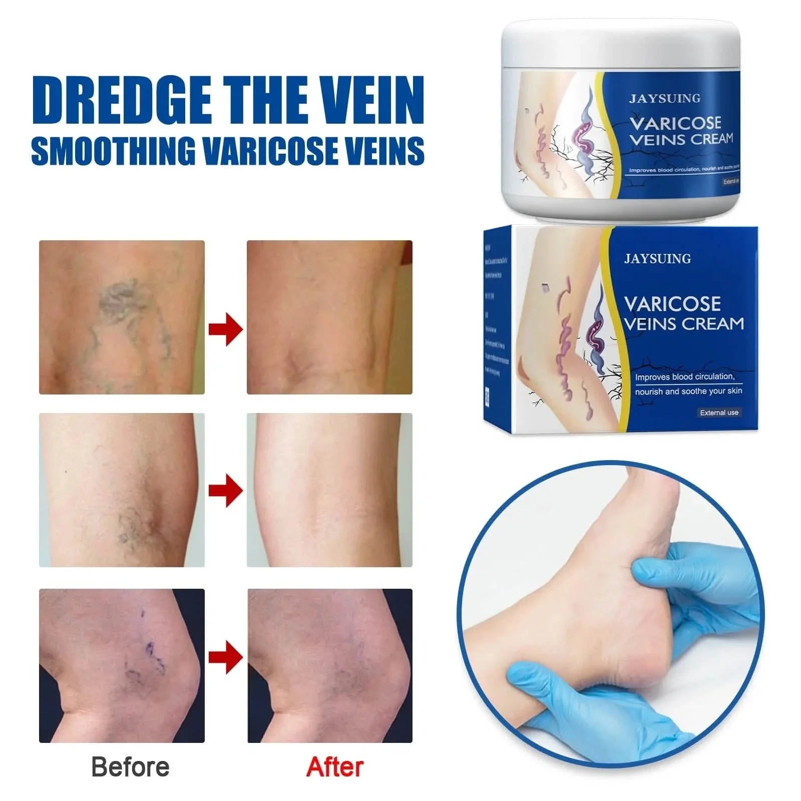 Pain Relief Leg Spider Veins Vasculitis Promote Circulation Smooth Metabolism 30g Exfoliation