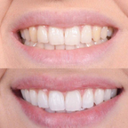 Quick Teeth Whitening for a Radiant Smile